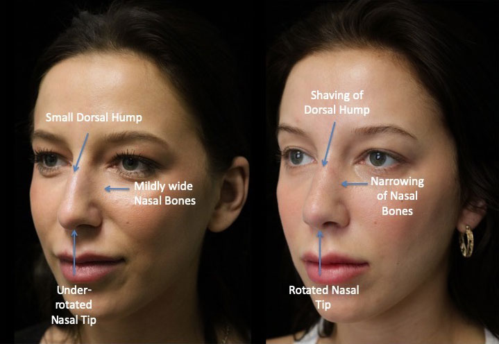 Before and after photo of a closed rhinoplasty dorsal hump reduction patient slightly facing right