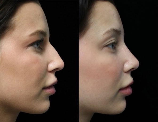 Photo of a closed rhinoplasty dorsal hump reduction patient facing left
