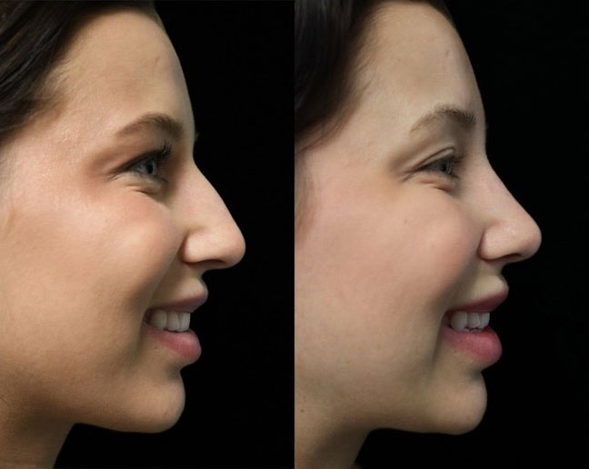 Before and after photo of a closed rhinoplasty dorsal hump reduction patient facing left