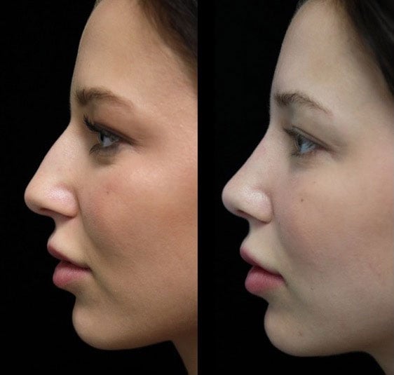A female patient after a closed rhinoplasty dorsal hump reduction