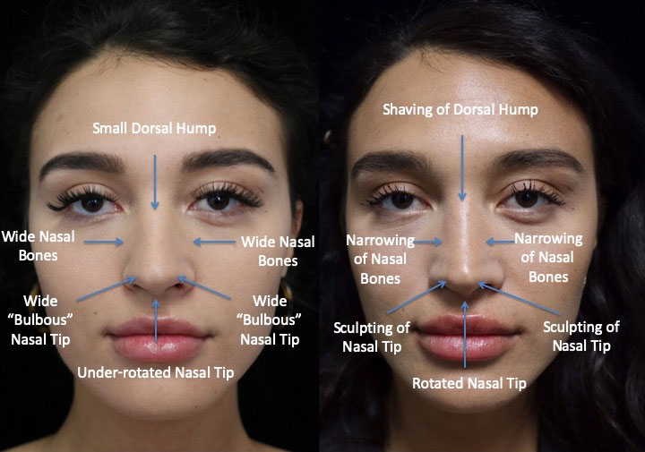 Front view of a female patient after a closed rhinoplasty dorsal hump reduction