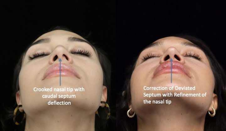 Perfect nasal tip of a female patient after a nasal tip refinement