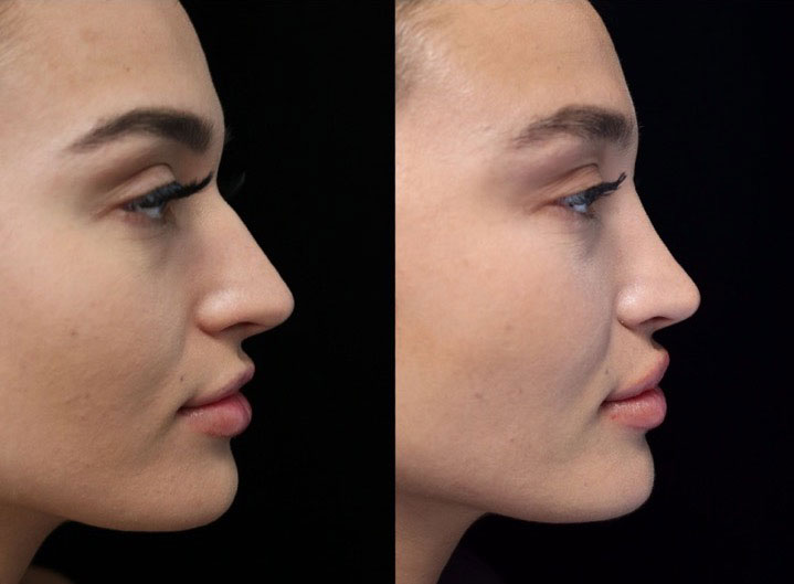 A female patient with a rotated nasal tip after a closed scarless rhinoplasty
