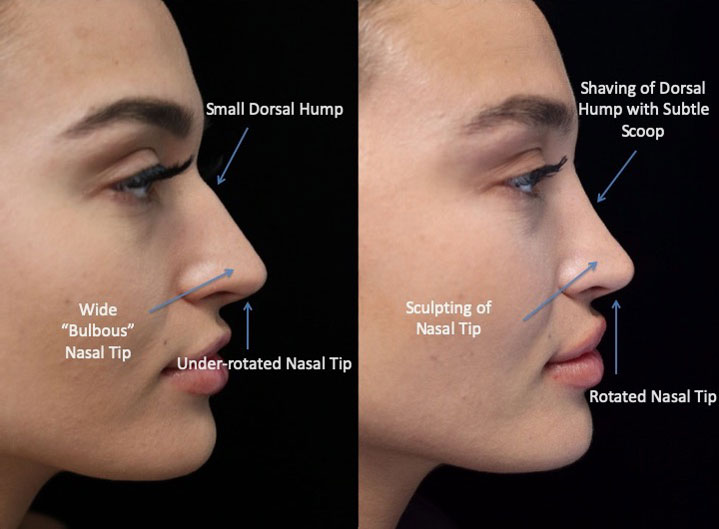A female patient with a rotated nasal tip after a closed scarless rhinoplasty