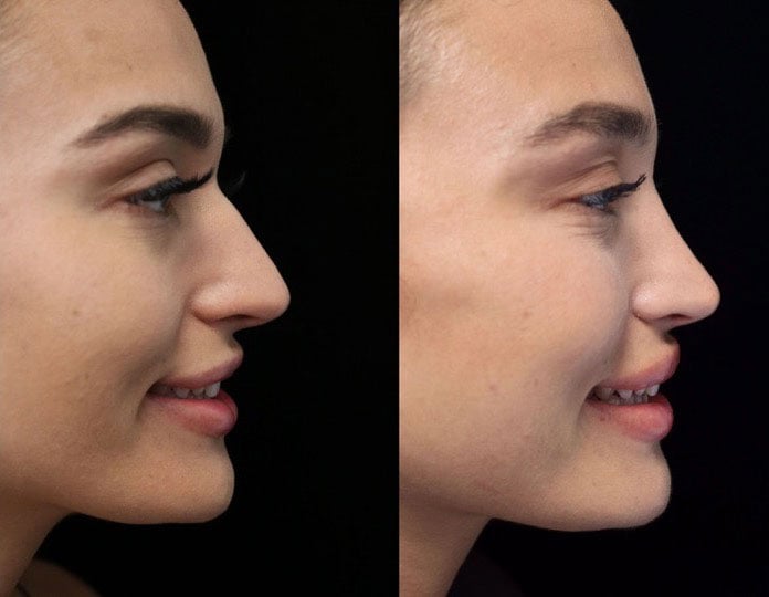 A woman with a perfect nasal tip after a nasal tip rhinoplasty