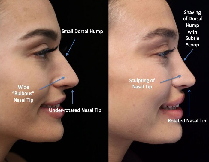 A woman with a perfect nasal tip after a nasal tip rhinoplasty