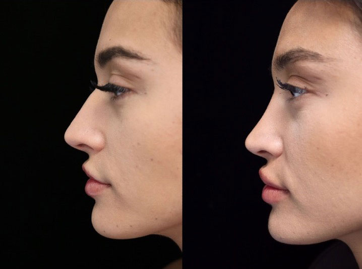 Photo of a female patient with a small dorsal hump before and after closed rhinoplasty