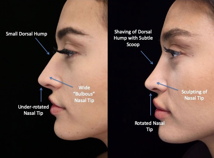 Photo of a female patient with a small dorsal hump before and after closed rhinoplasty