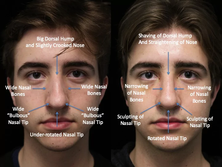 A male scarless rhinoplasty patient with a big dorsal hump