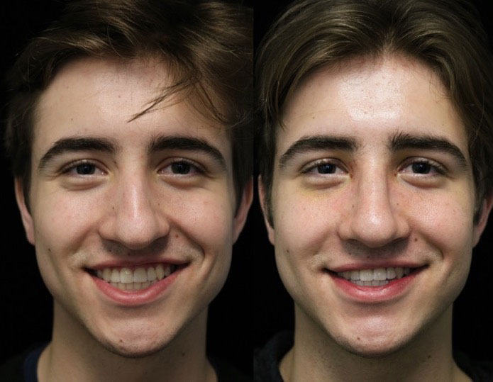 Closed rhinoplasty before and after photo of a male patient