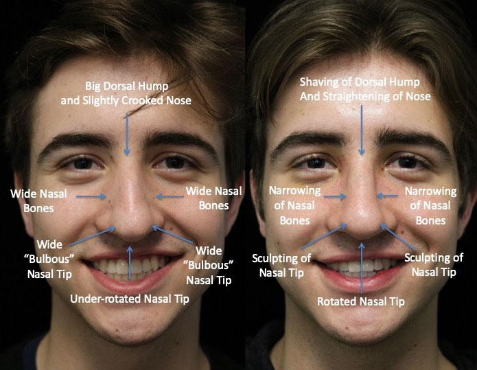 Closed rhinoplasty before and after photo of a male patient
