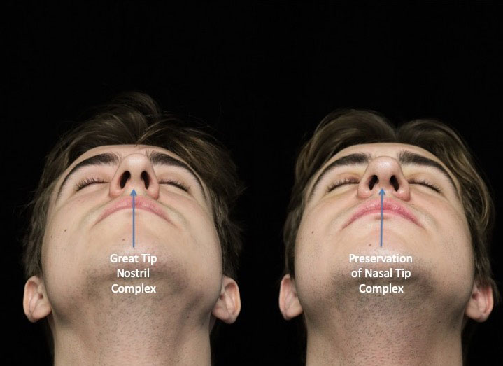 A male closed rhinoplasty patient with a defined nose tip