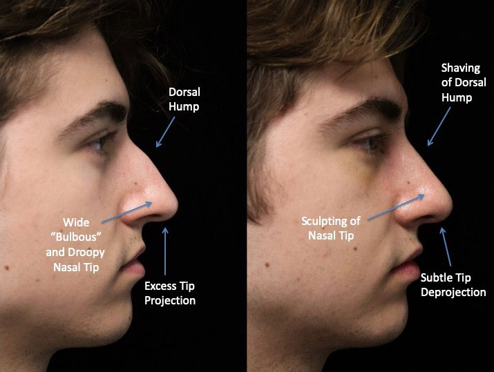 A male patient after a dorsal hump nose job