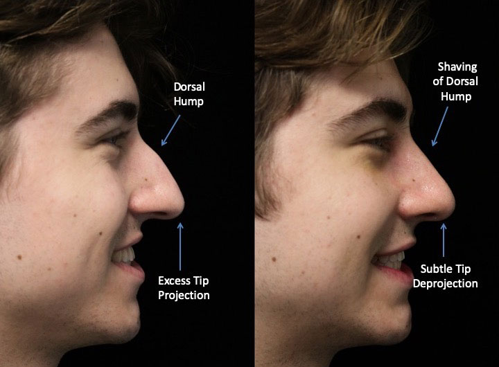A man facing left with a dorsal hump nose who underwent a dorsal hump nose job