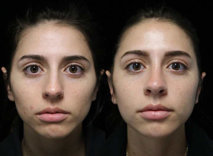 Front view of a female patient after closed rhinoplasty