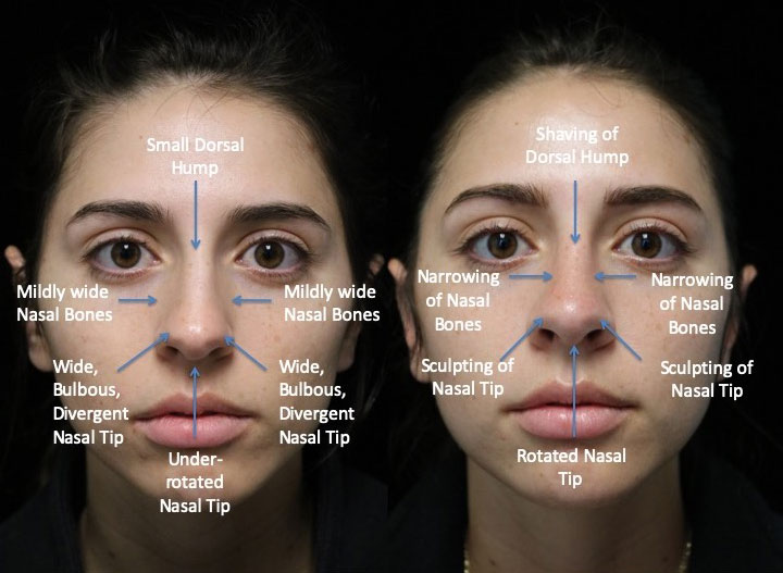Front view of a female patient after closed rhinoplasty