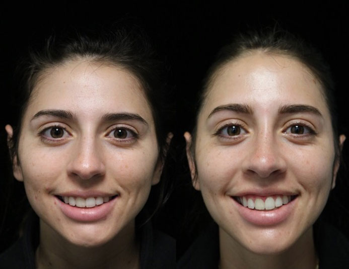 Closed rhinoplasty before and after photo of a female patient