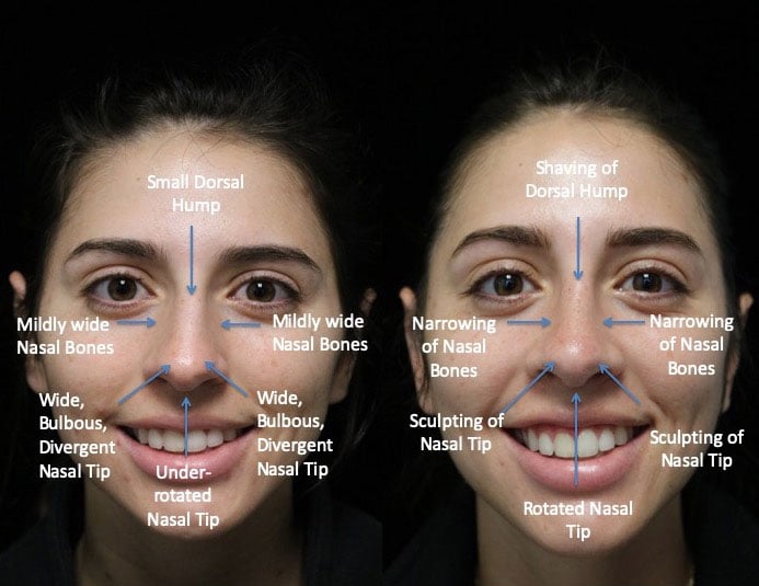 Closed rhinoplasty before and after photo of a female patient