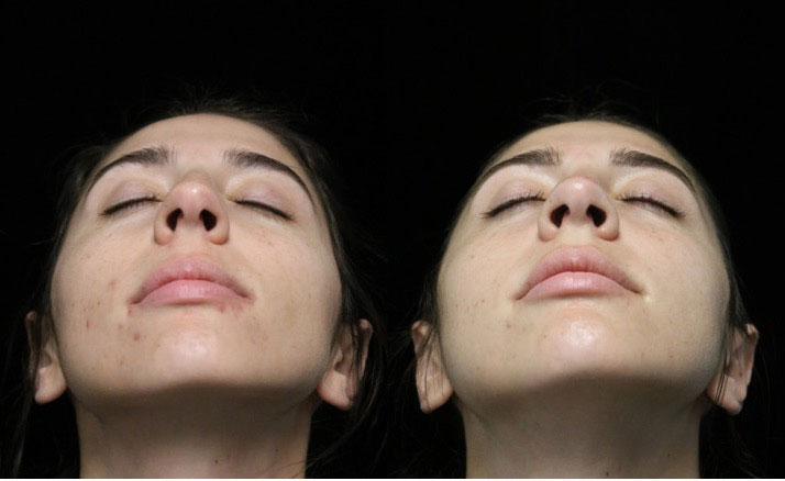 Refined nose of a female patient after bulbous nose tip reduction