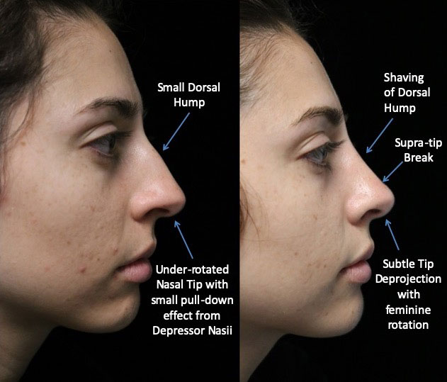 A female patient facing left after a closed rhinoplasty dorsal hump reduction