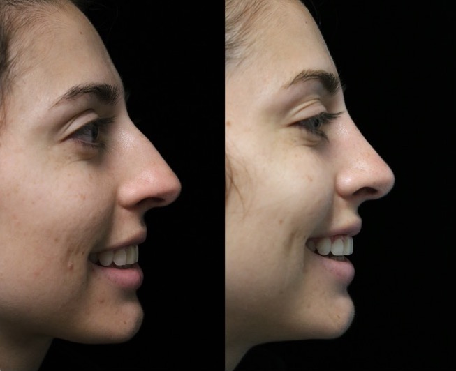Photo of a female patient facing left after a closed rhinoplasty dorsal hump reduction