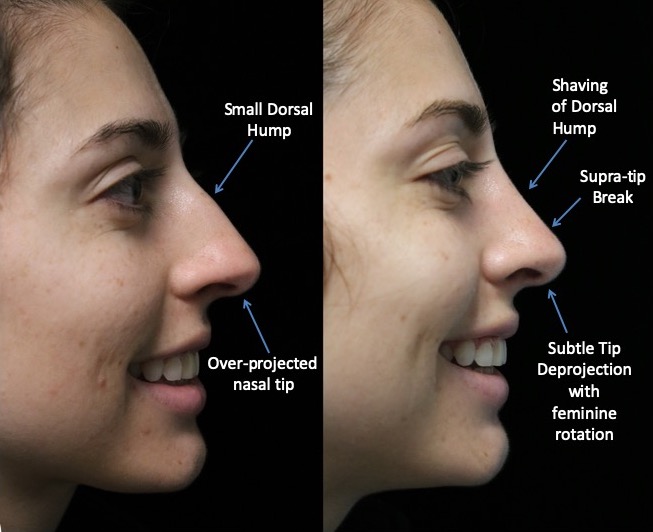 Photo of a female patient facing left after a closed rhinoplasty dorsal hump reduction