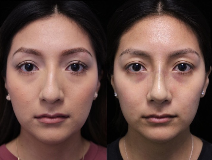 Front view of a female patient after a closed rhinoplasty