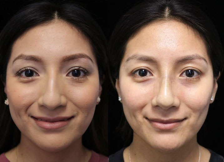 A female patient after a closed rhinoplasty