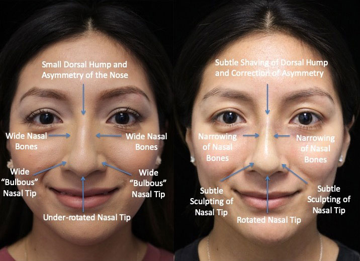 A female patient after a closed rhinoplasty