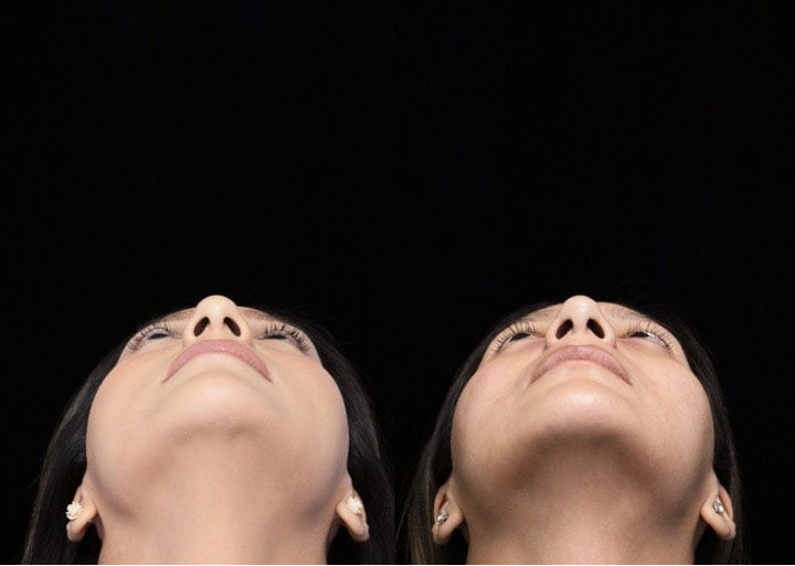 Before and after photo of a female patient who underwent a nasal tip rhinoplasty