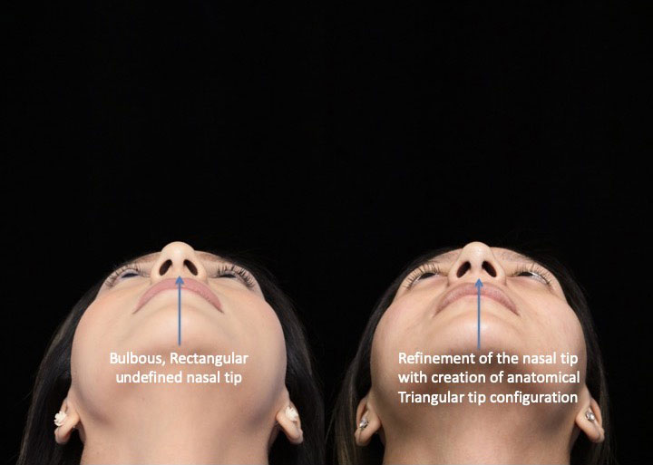Female patient's tip of nose after rhinoplasty