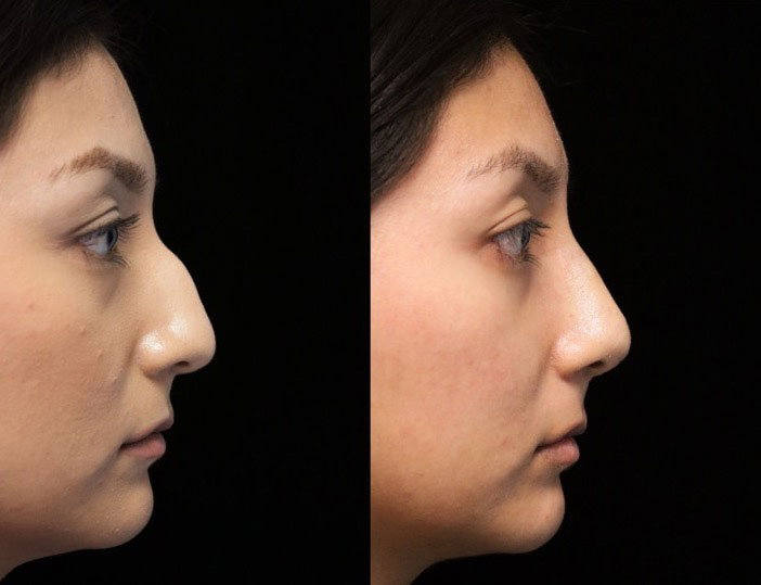 Female patient's dorsal hump after rhinoplasty