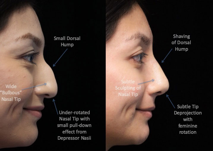 Bulbous nose job female patient before and after photo facing left