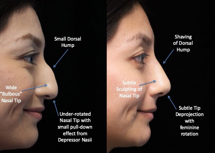 Bulbous nose job female patient before and after photo facing left