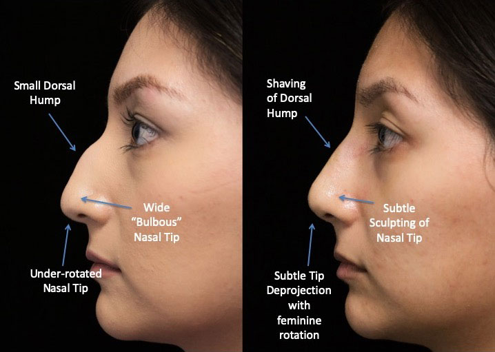 Photo of a female patient with a bulbous nose after rhinoplasty