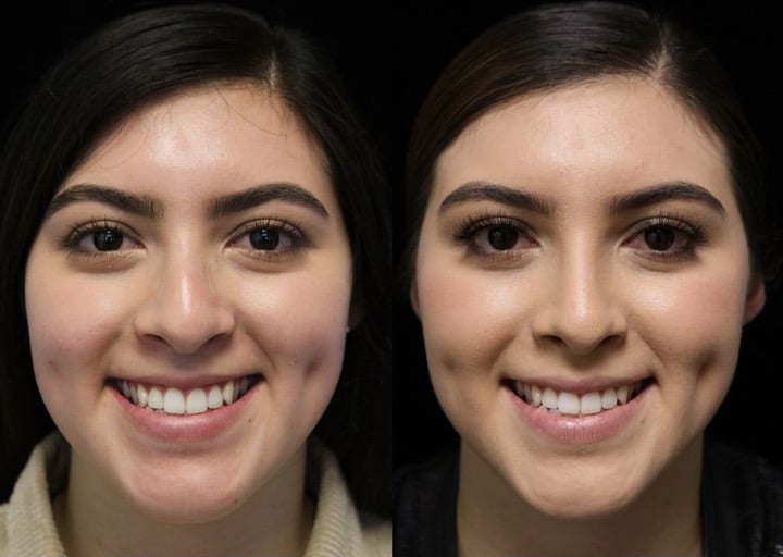 Before and after front view photo of a woman who underwent dorsal hump non surgical nose job