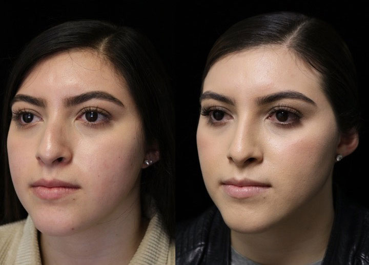 Rhinoplasty dorsal hump before and after photo of a woman slightly facing right