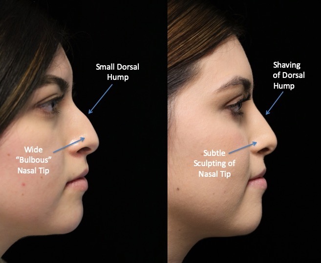 Before and after photo of a woman facing left who underwent rhinoplasty hump reduction