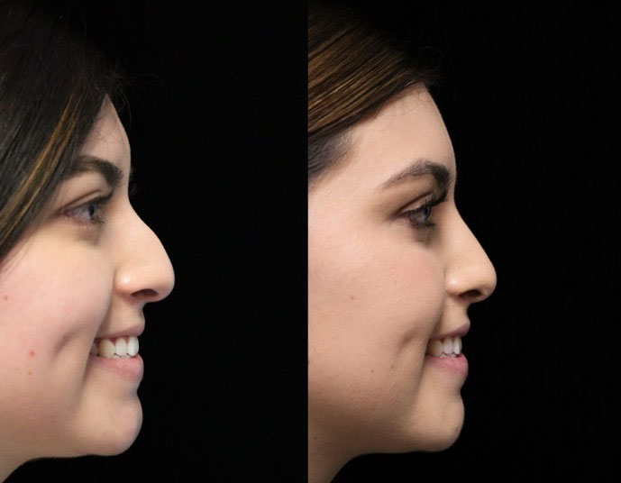 A woman facing left with a dorsal hump nose who underwent a dorsal hump nose job