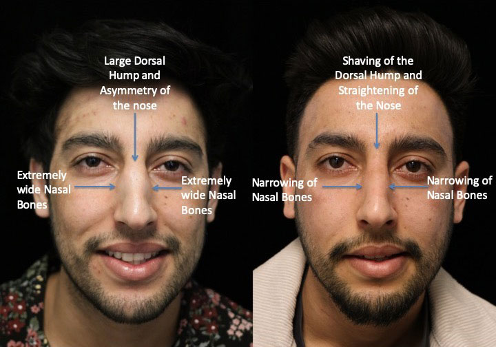 Before and after photo of a man with a narrowed nasal bone after a scarless rhinplasty