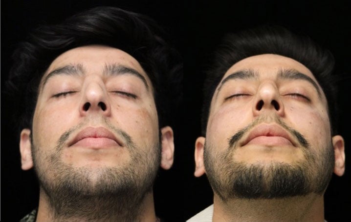 A man with a perfect nasal tip after a nasal tip rhinoplasty
