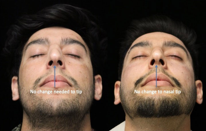 A man with a perfect nasal tip after a nasal tip rhinoplasty