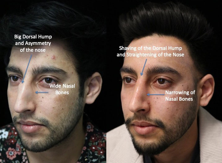 A man slightly facing right with a narrowed nasal bones after a dorsal hump rhinoplasty