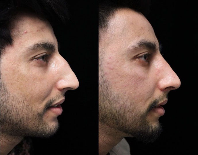 A man facing left with a minimal dorsal hump after a dorsal hump rhinoplasty