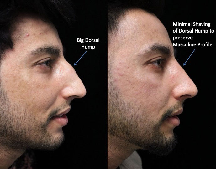 A man facing left with a minimal dorsal hump after a dorsal hump rhinoplasty