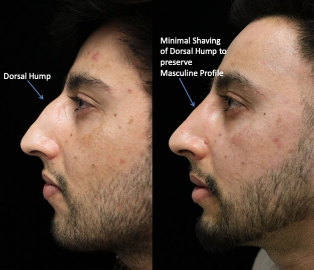 A man facing right with a minimal dorsal hump after a dorsal hump rhinoplasty