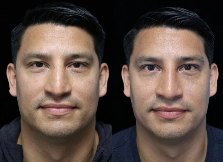 Photo of a smiling male patient with a small dorsal hump after rhinoplasty