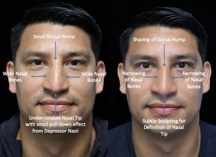 Before and after photo of a man with wide nasal bones who underwent rhinoplasty