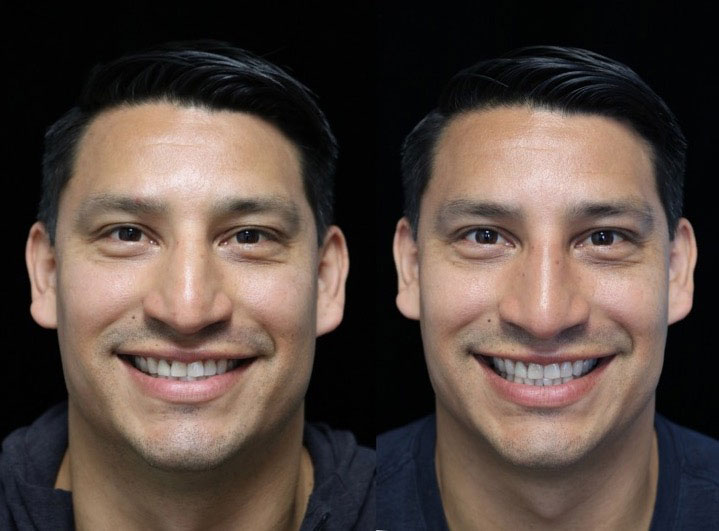 Photo of a male patient with a small dorsal hump after rhinoplasty
