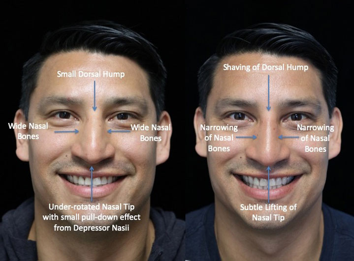 Before and after photo of man with a narrowed nasal bones after a rhinoplasty